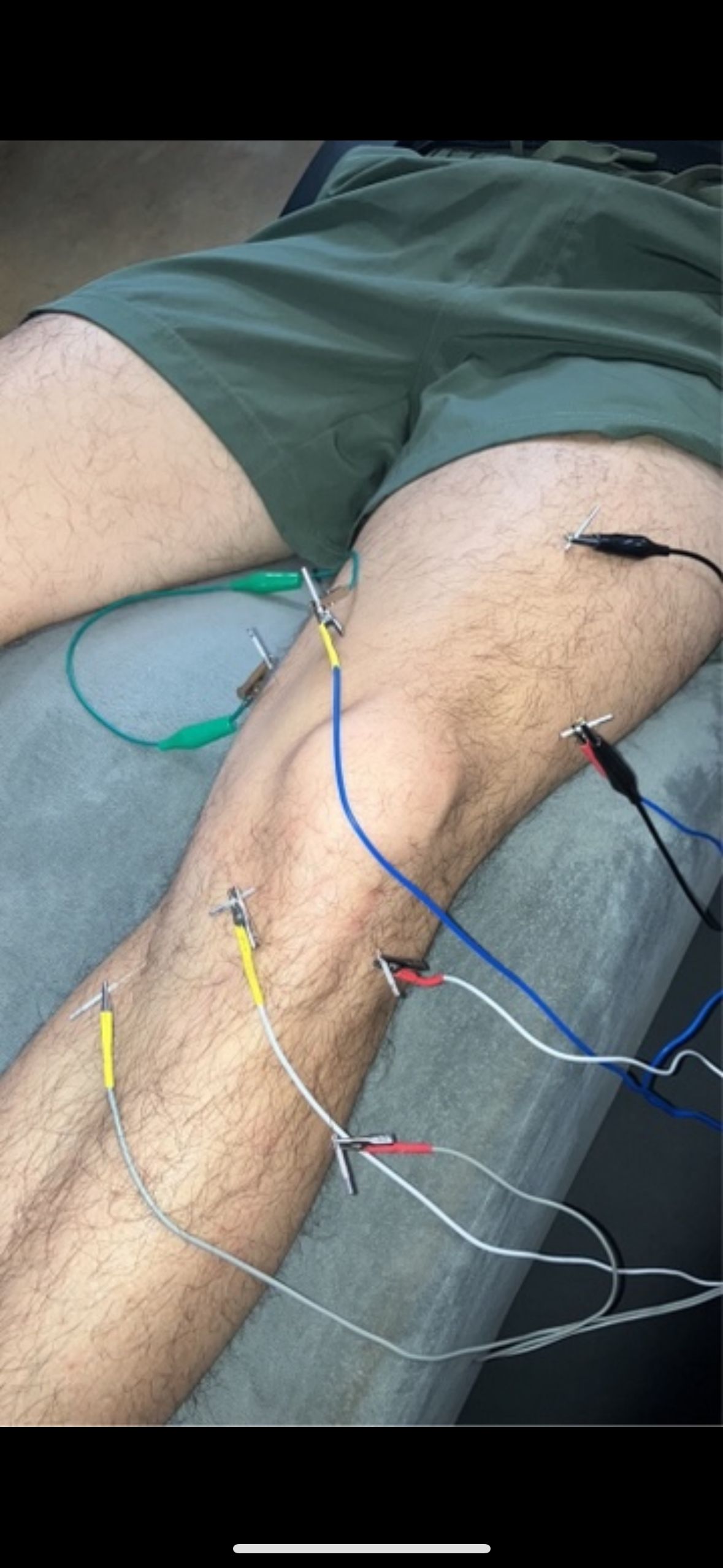 Dry needling knee treatment with e-stim at GT Physical Therapy Pascagoula