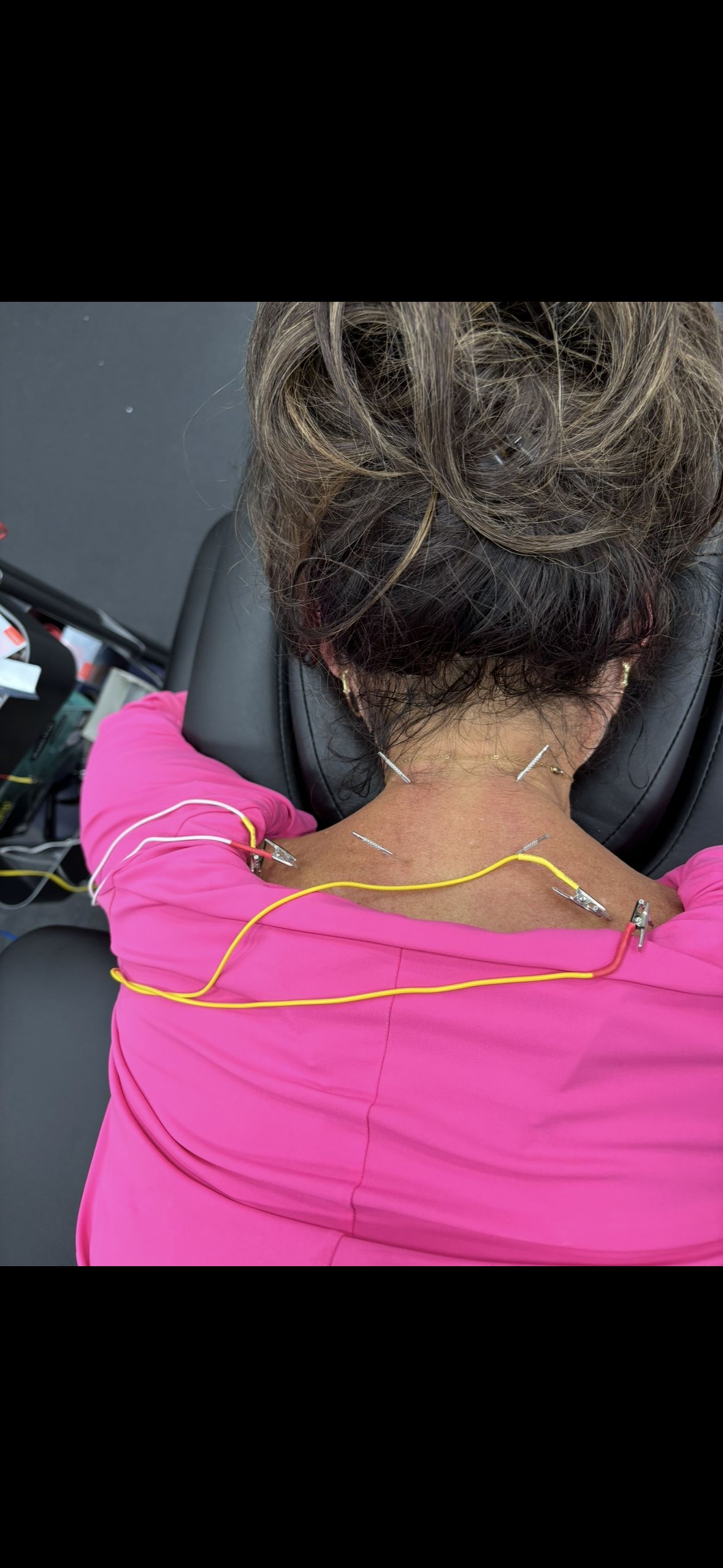 Dry needling neck and shoulder Pascagoula MS — GT Physical Therapy