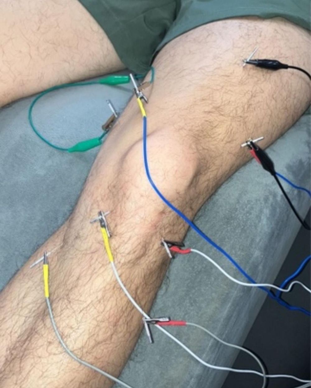 Dry needling with electrical stimulation around a patient's knee