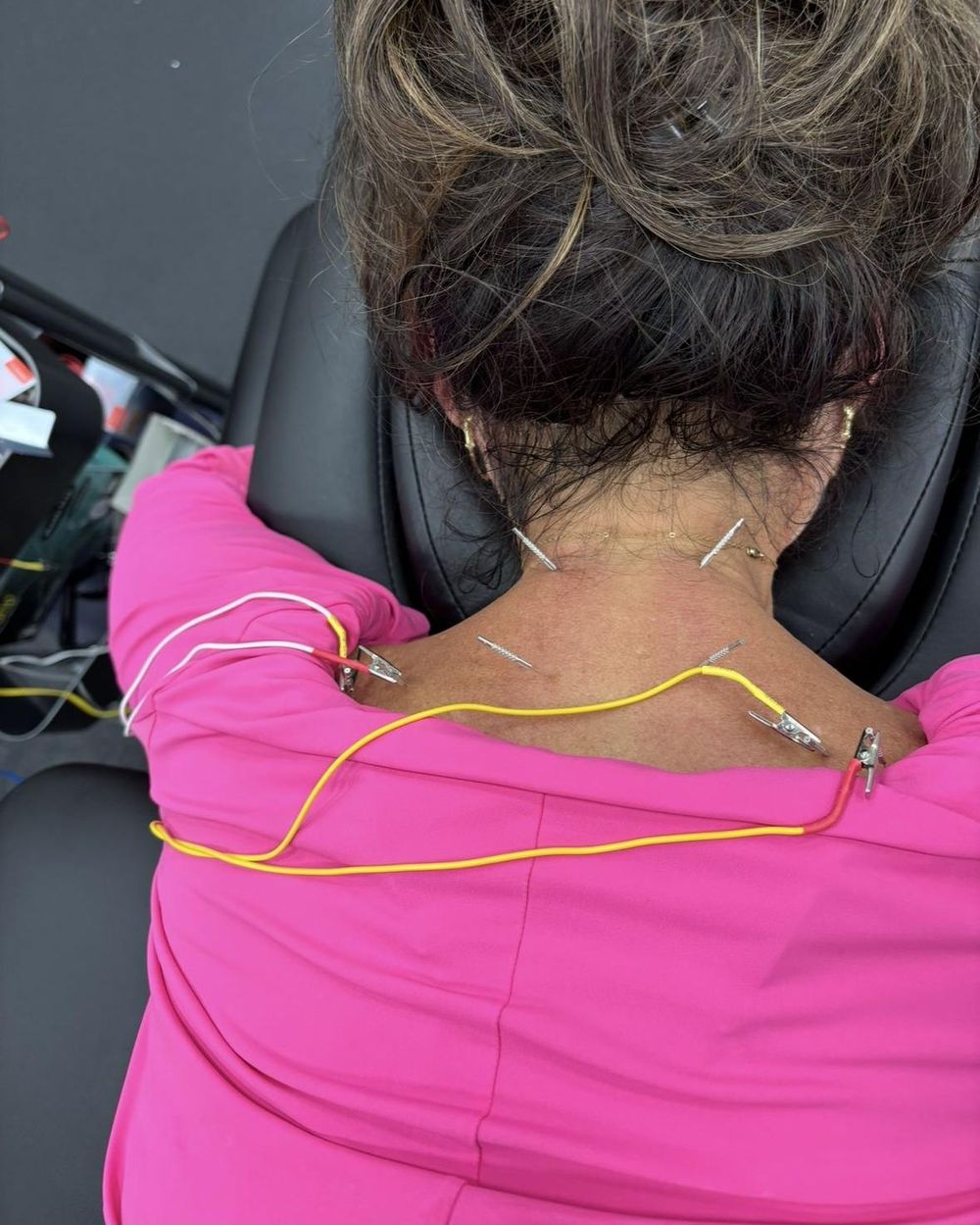 Dry needling with electrical stimulation along a patient's neck and upper back